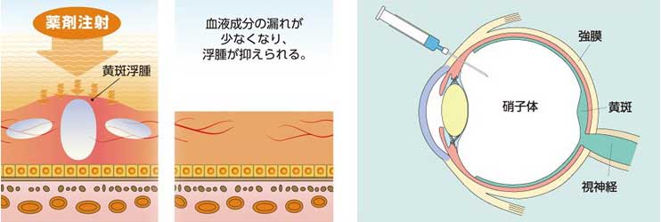 Intravitreal injection