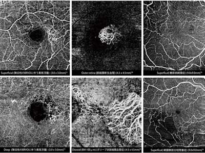 光干渉断層血管撮影（OCTアンギオグラフティー）