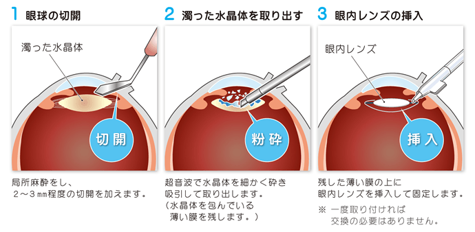 白内障手術で使用する眼内レンズ