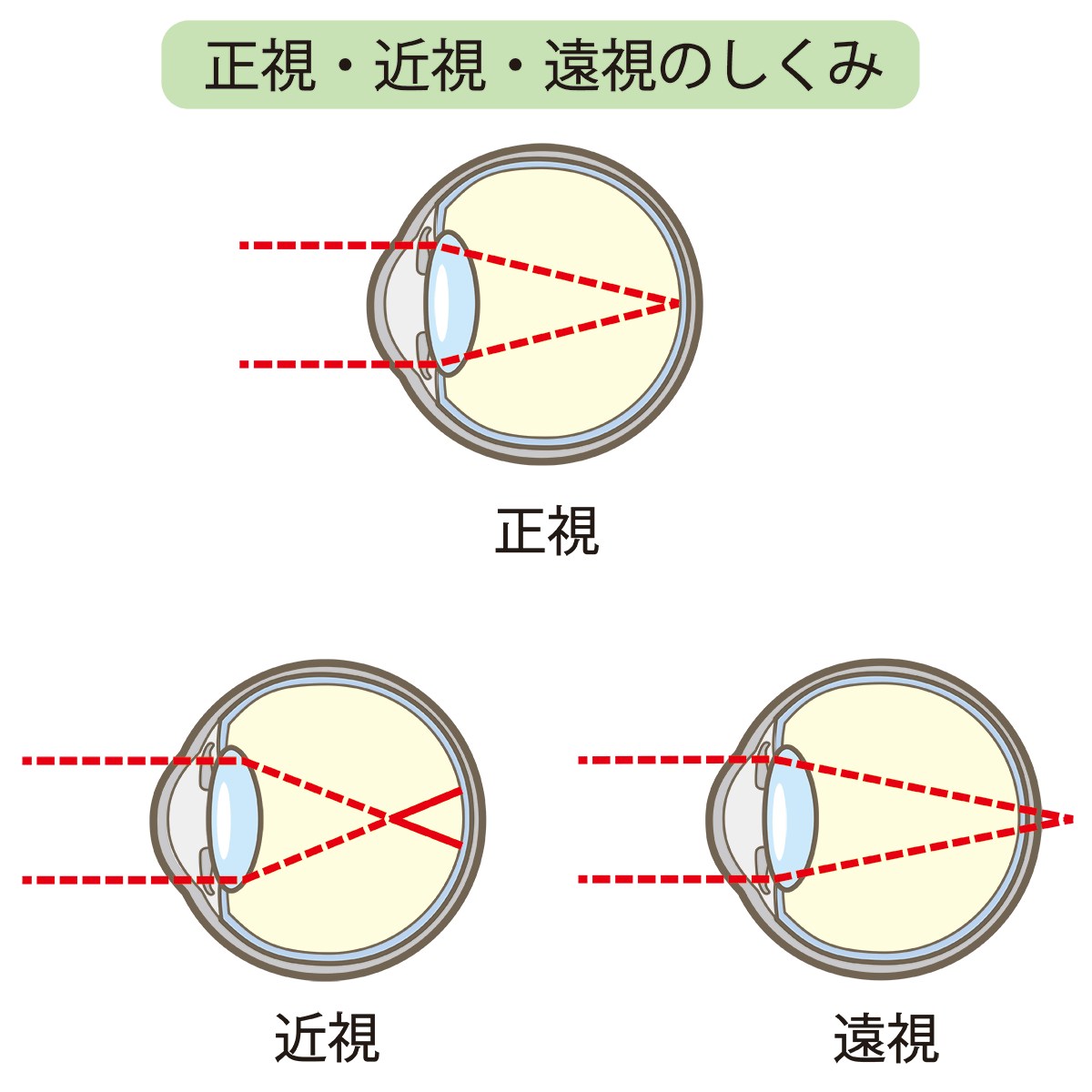 見えにくさの原因「屈折異常」とは？